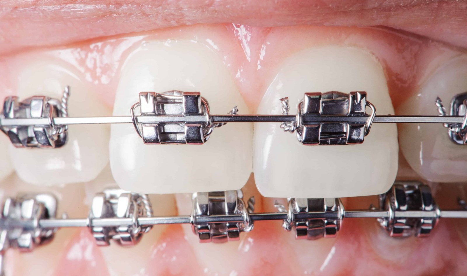 close-up-dental-braces-on-teeth-orthodontic-treat-2022-05-09-23-21-18-utc (1)